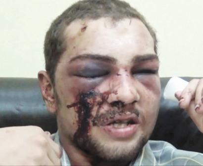 مواطن من سكان مدينة نصر تعرض للضرب وبتر إحدى أصابع يده اليمنى على أيدي أنصار مرسي في ميدان رابعة العدوية